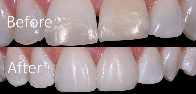 Can You Whiten Composite Veneers Can You Whiten Composite Veneers
