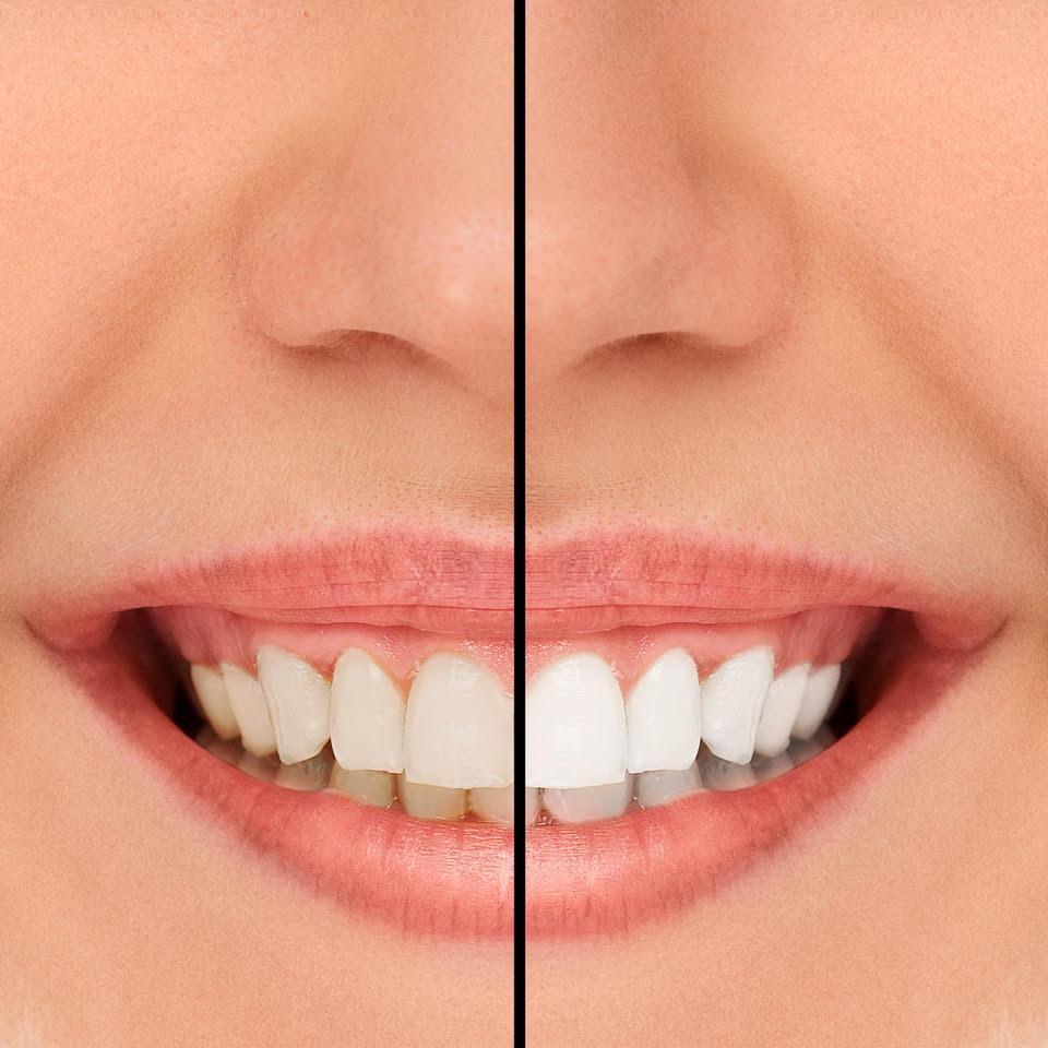Can You Whiten Composite Veneers Can You Whiten Composite Veneers