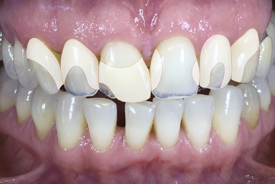 Can You Whiten Composite Veneers Can You Whiten Composite Veneers