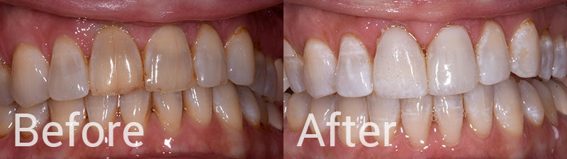 Can You Whiten Composite Veneers Can You Whiten Composite Veneers