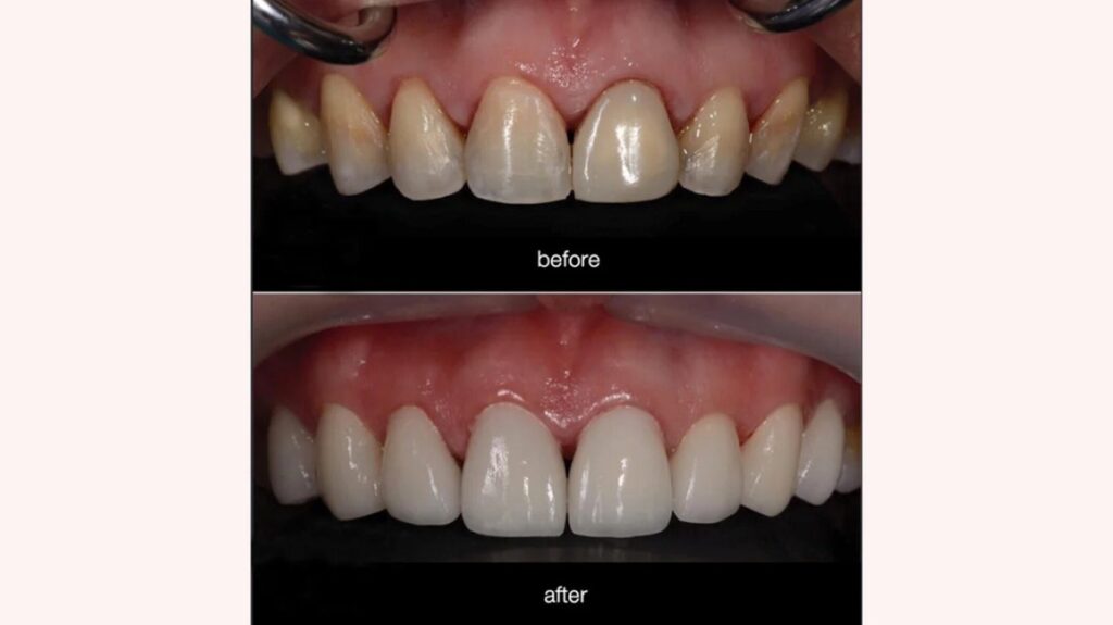 Composite Veneers Before And After