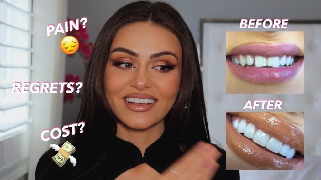 Composite Veneers Before And After