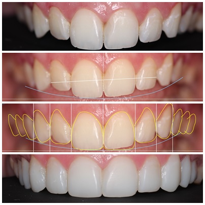 Composite Veneers Before And After