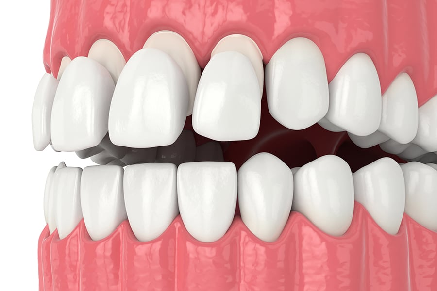 Composite Veneers Cost