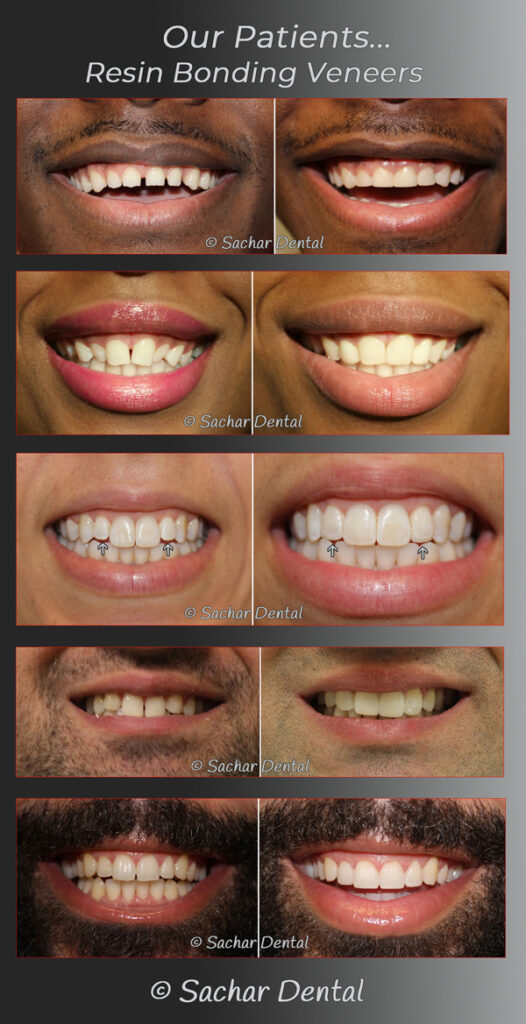 Composite Veneers Cost