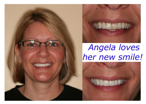 Composite Veneers Cost