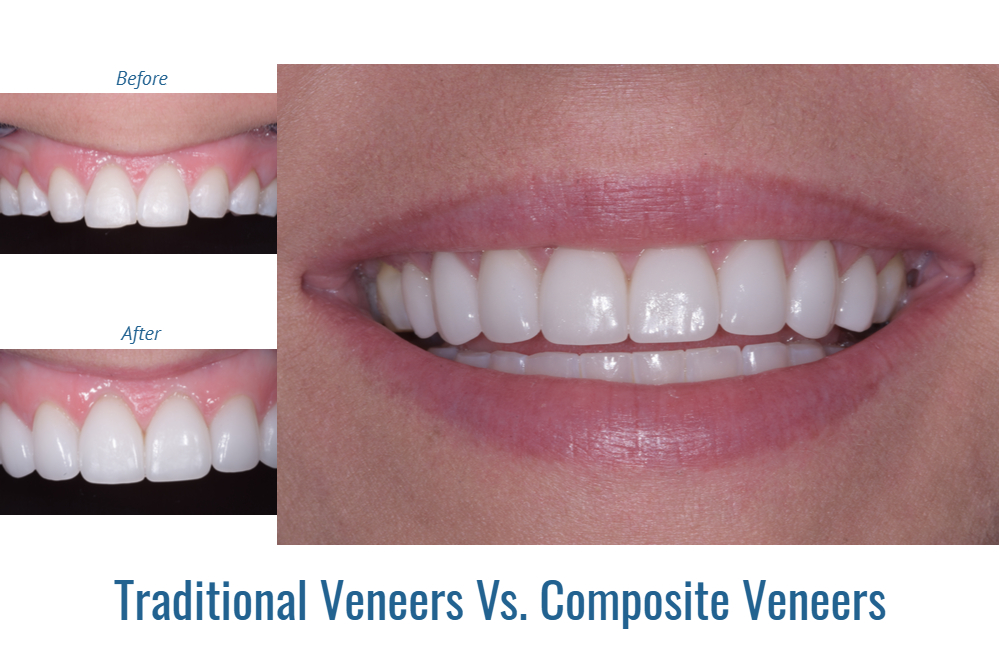 Composite Veneers Cost