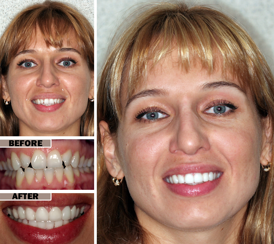 Cosmetic Dental Bonding Cosmetic Dental Bonding