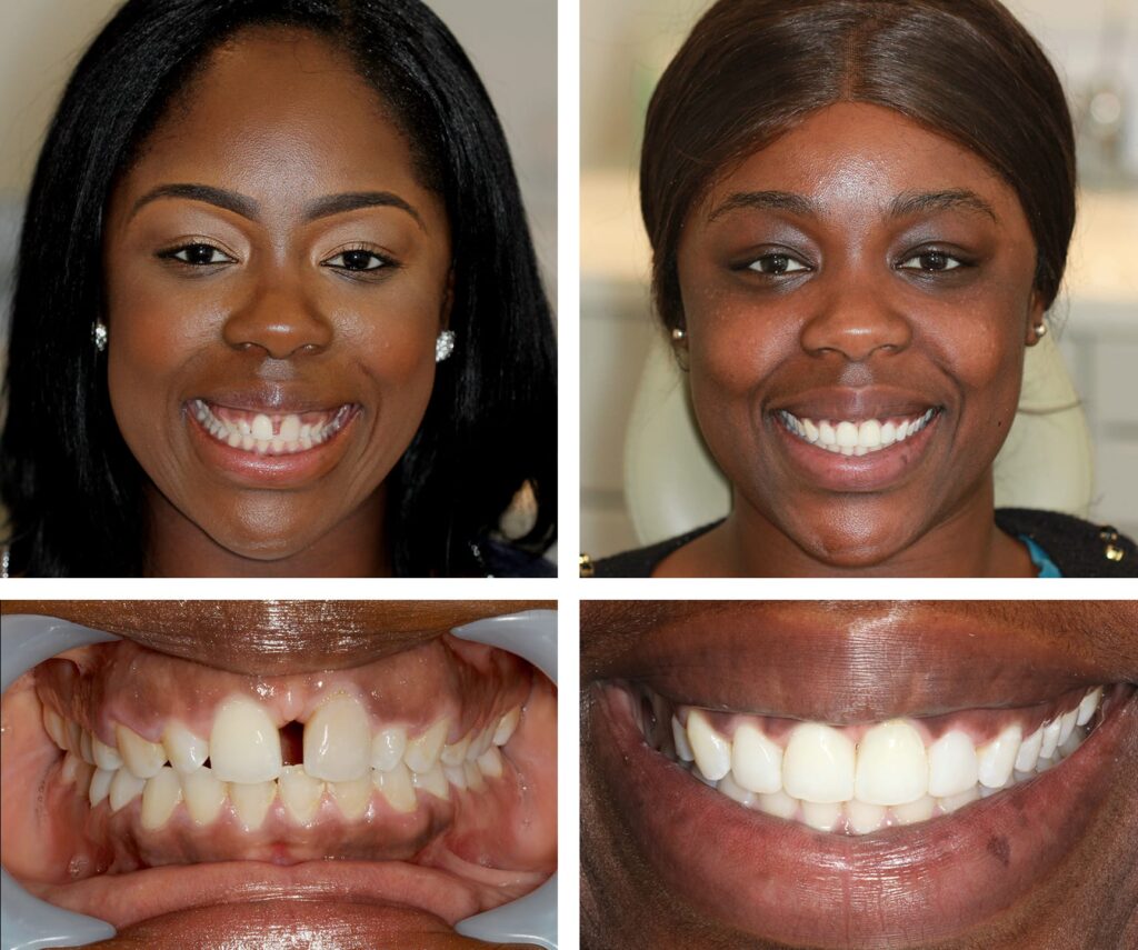 Cosmetic Dental Bonding Cosmetic Dental Bonding