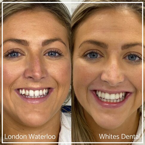Cosmetic Dental Bonding Cosmetic Dental Bonding