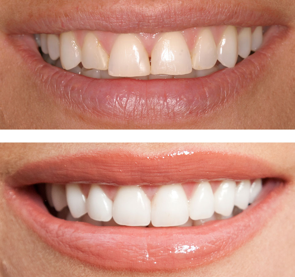 Cosmetic Dental Bonding Cosmetic Dental Bonding
