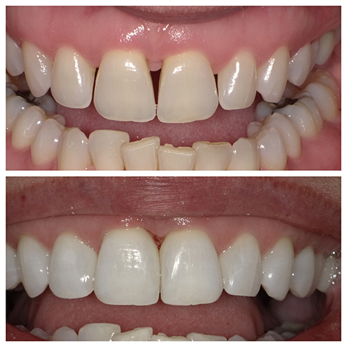 Cosmetic Dental Bonding Cosmetic Dental Bonding