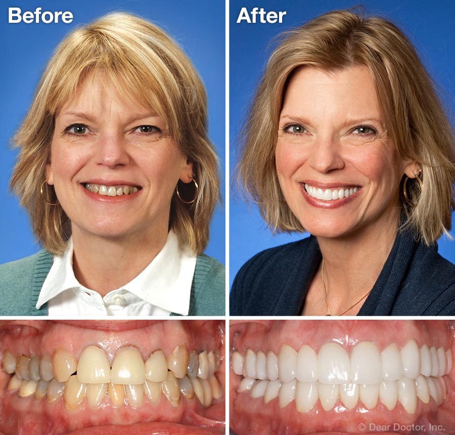 Cosmetic Dental Work