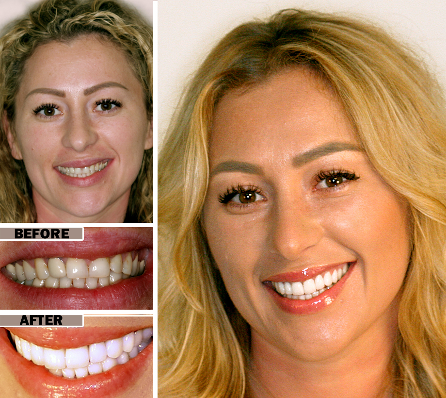 Cosmetic Dental Work