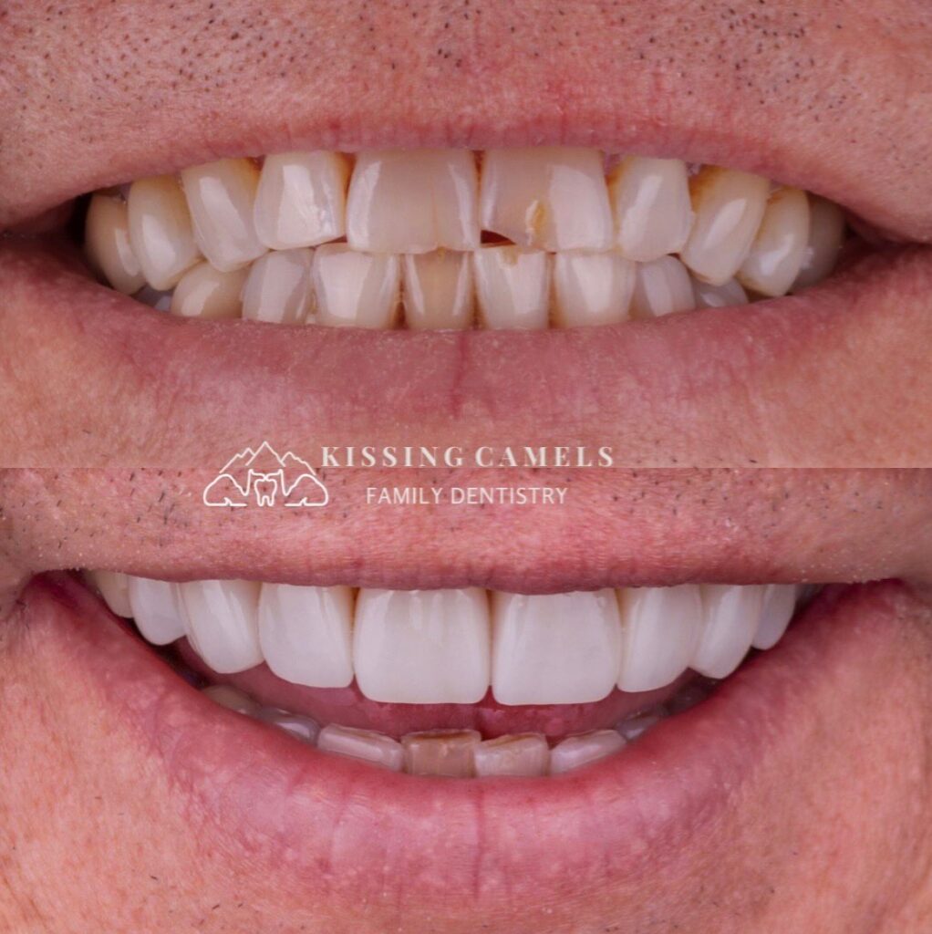 Cosmetic Dentist In Colorado Springs Colorado