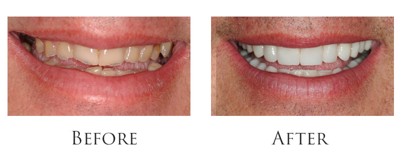 Cosmetic Dentist In Indianapolis Indiana Cosmetic Dentist In Indianapolis Indiana