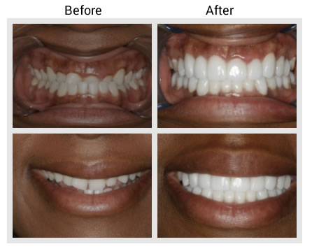 Cosmetic Dentistry Near Me Veneers Cosmetic Dentistry Near Me Veneers