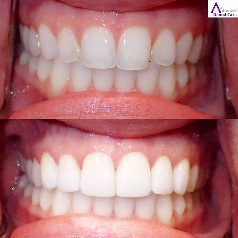 Cosmetic Dentistry Near Me Veneers Cosmetic Dentistry Near Me Veneers