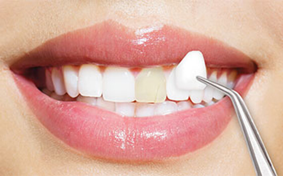 Cosmetic Dentistry Near Me Veneers Cosmetic Dentistry Near Me Veneers