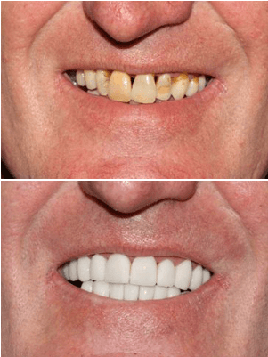 Cosmetic Dentistry Near Me Veneers Cosmetic Dentistry Near Me Veneers