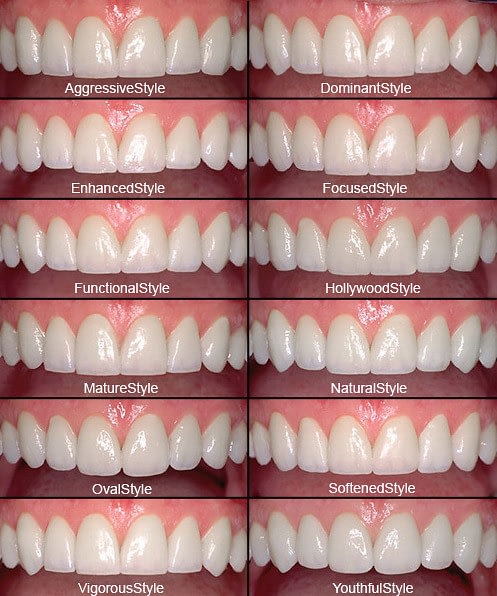 Cosmetic Veneers Near Me