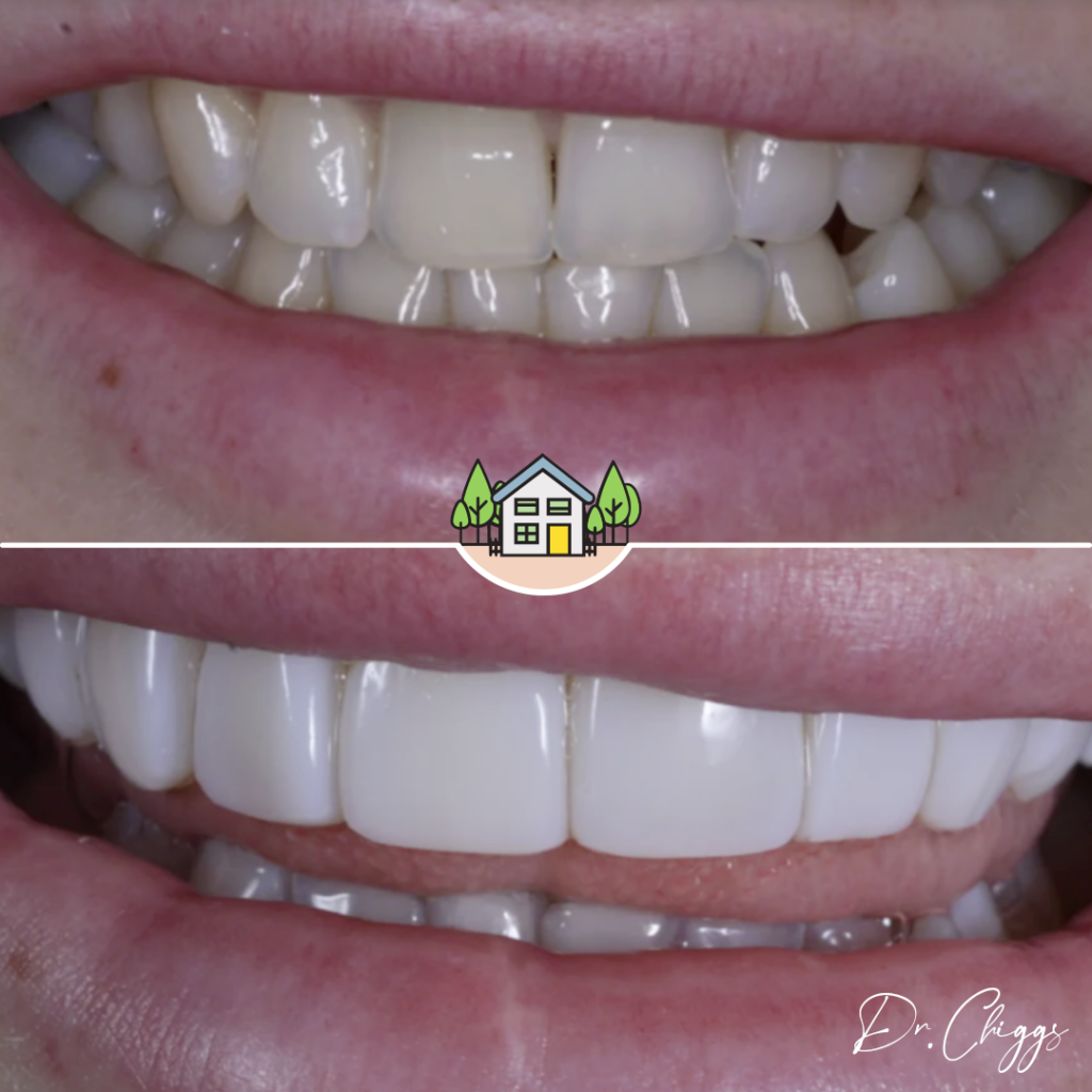How Long Do Composite Veneers Last