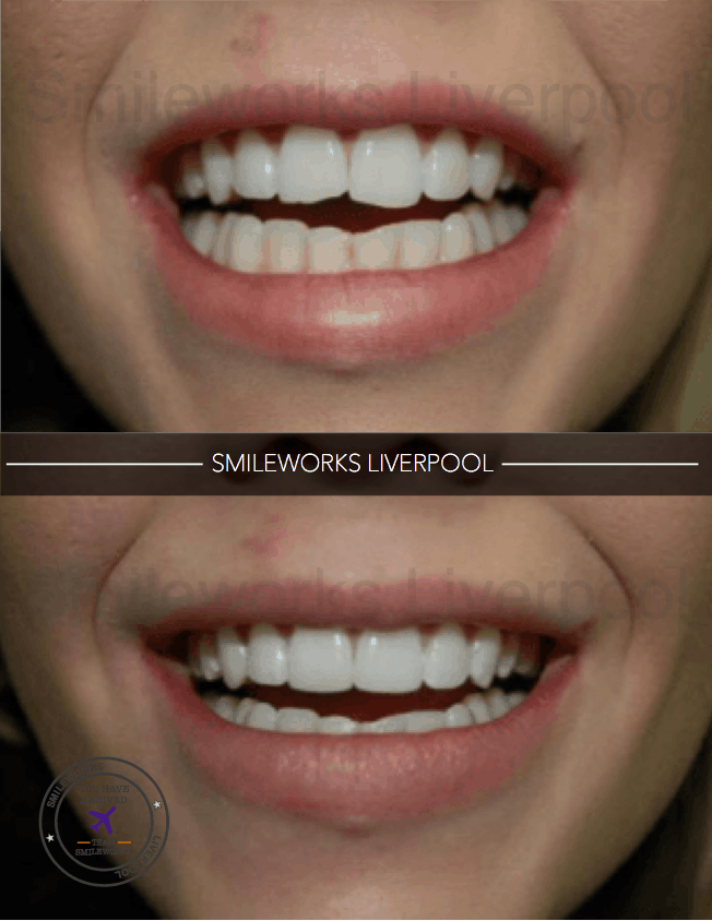 How Long Do Composite Veneers Last