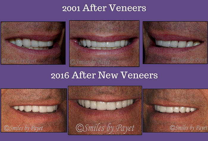 How Long Do Porcelain Veneers Last How Long Do Porcelain Veneers Last