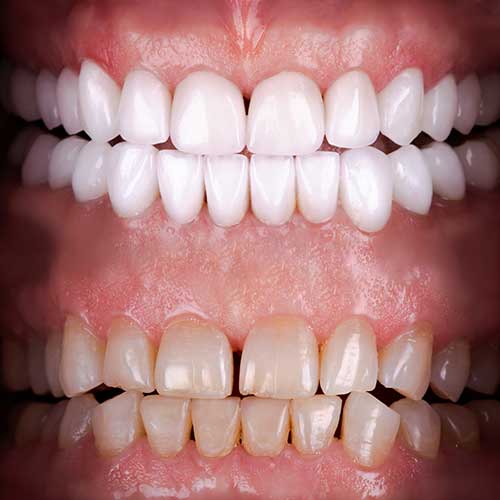 How Long Do Porcelain Veneers Last How Long Do Porcelain Veneers Last