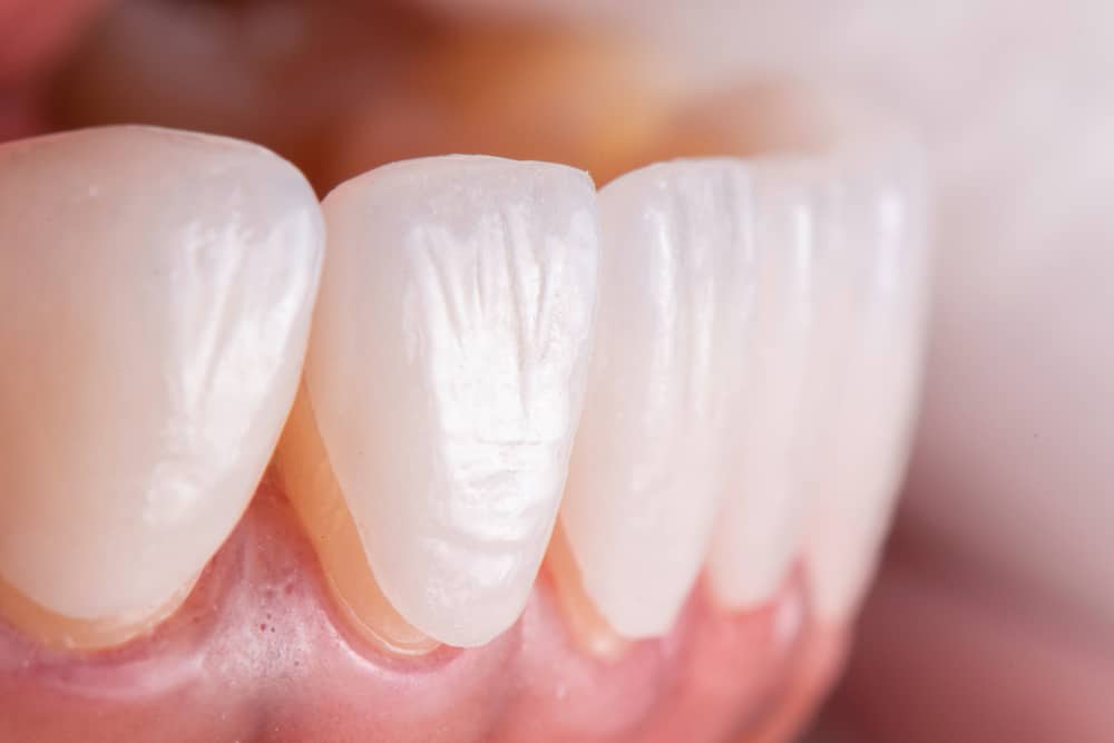 How Long Do Veneers Last