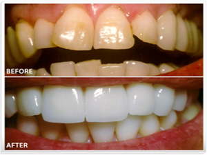 How Long Do Veneers Last