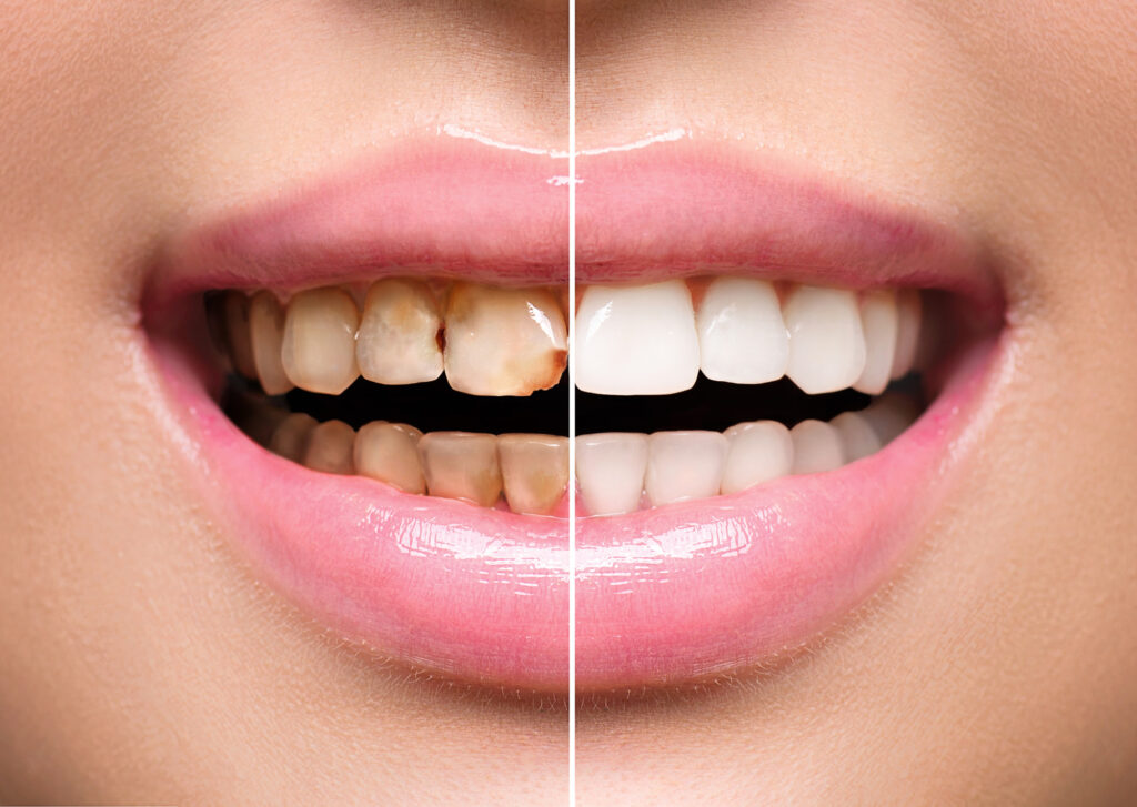 How Long Do Veneers Last