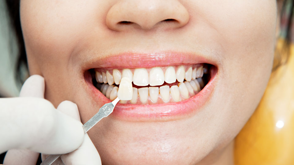 Top Cosmetic Dentist in South San Francisco