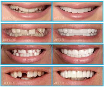 Pop On Veneers