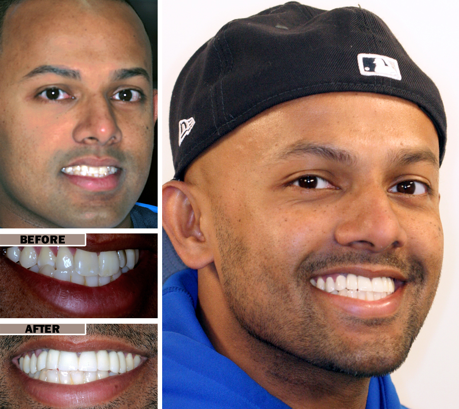 Porcelain Veneers Before And After