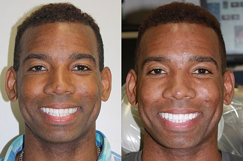 Porcelain Veneers Before And After