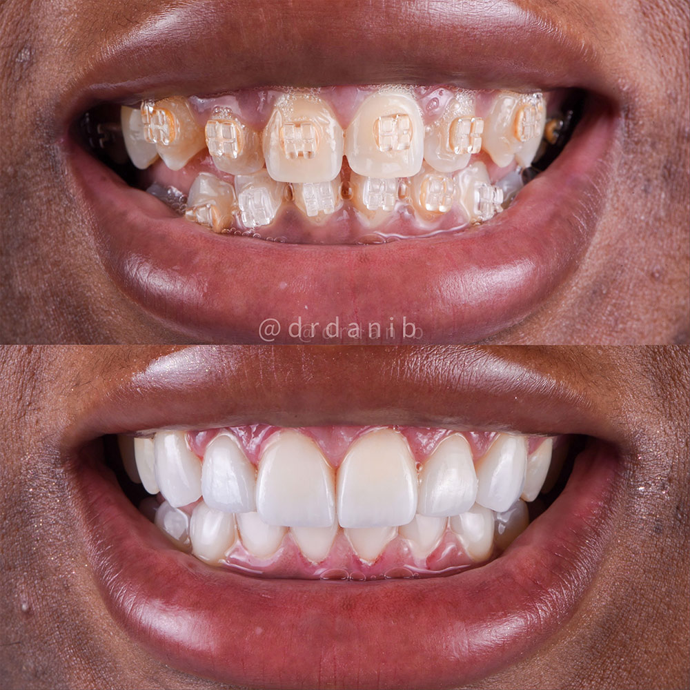 Porcelain Veneers Before And After