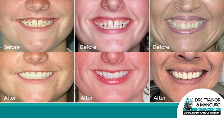 Porcelain Veneers Before And After