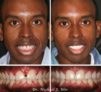 Porcelain Veneers Before And After