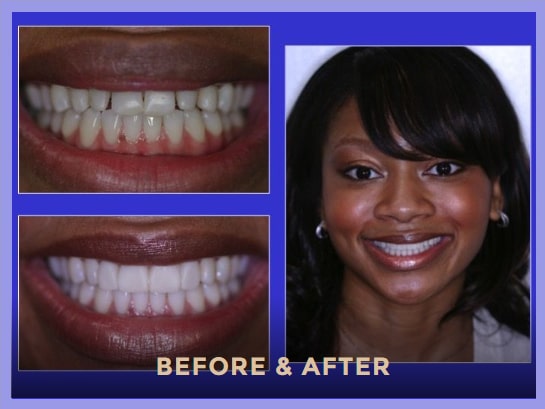 Porcelain Veneers Chicago Porcelain Veneers Chicago