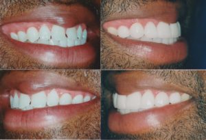 Porcelain Veneers Chicago Porcelain Veneers Chicago
