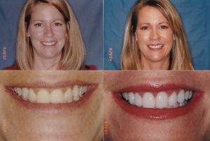 Porcelain Veneers Chicago Porcelain Veneers Chicago