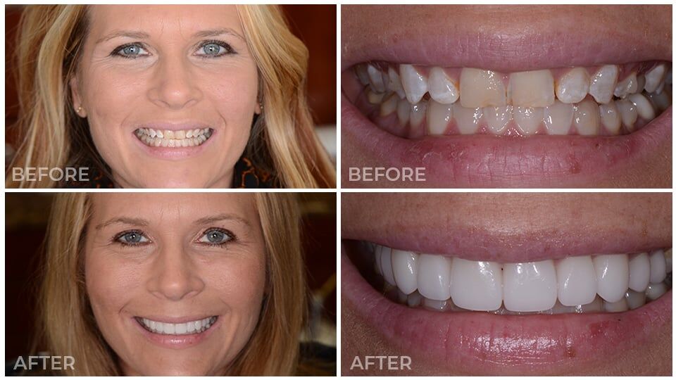 Porcelain Veneers Cost Porcelain Veneers Cost