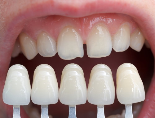 Porcelain Veneers Cost Porcelain Veneers Cost