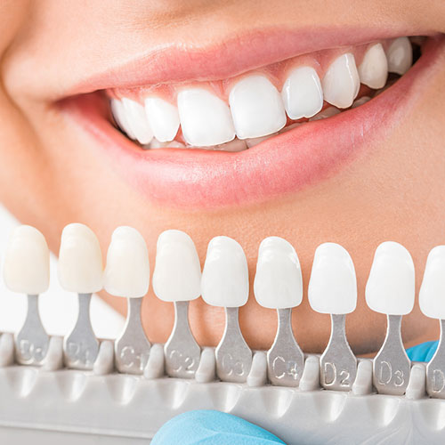 Porcelain Veneers Cost Porcelain Veneers Cost