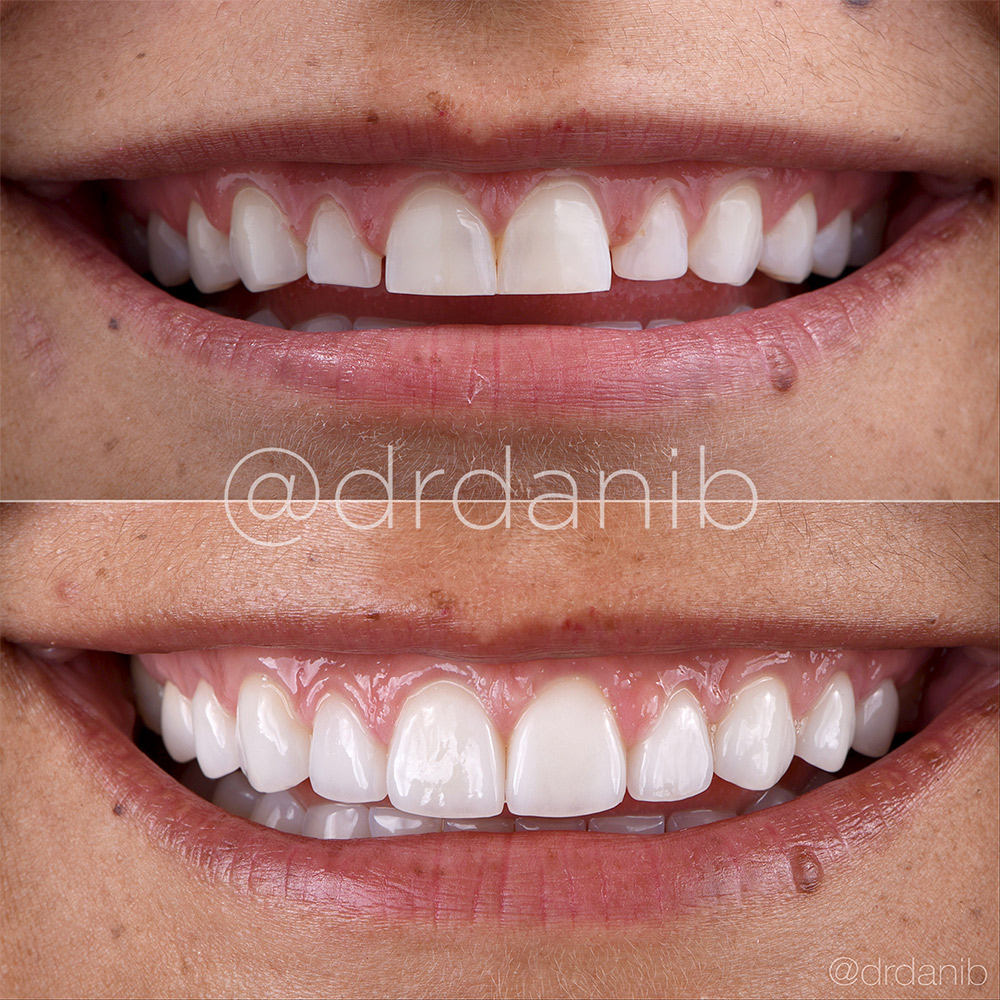 Porcelain Veneers Cost Porcelain Veneers Cost