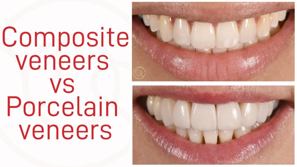 Porcelain Veneers Vs Composite Veneers Porcelain Veneers Vs Composite Veneers