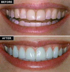 Porcelain Veneers Vs Composite Veneers Porcelain Veneers Vs Composite Veneers