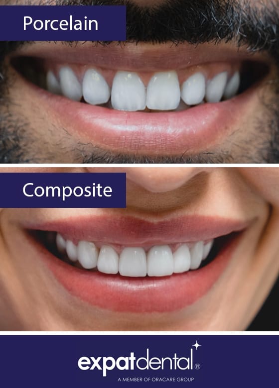 Porcelain Veneers Vs Composite Veneers Porcelain Veneers Vs Composite Veneers