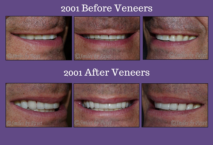 Veneers After 10 Years